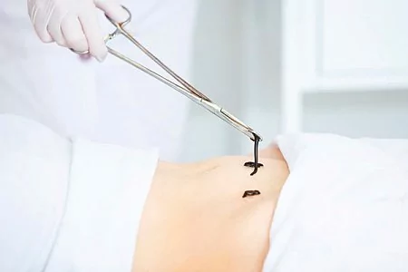 Гирудотерапия в гинекологии